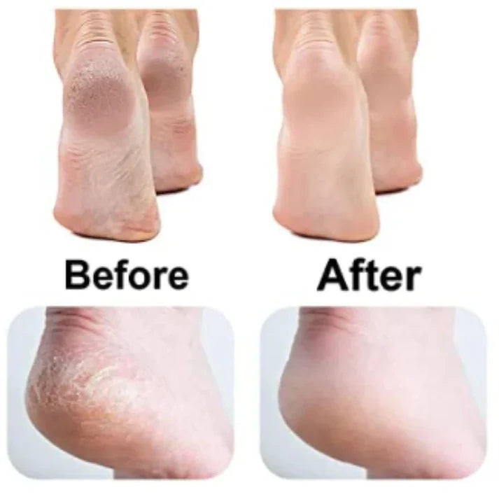 Electric Pedicure Foot Callus Grinder USB Charging